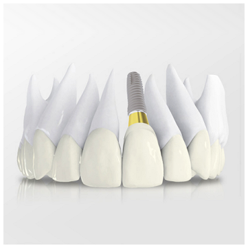implanty zębów bielsko